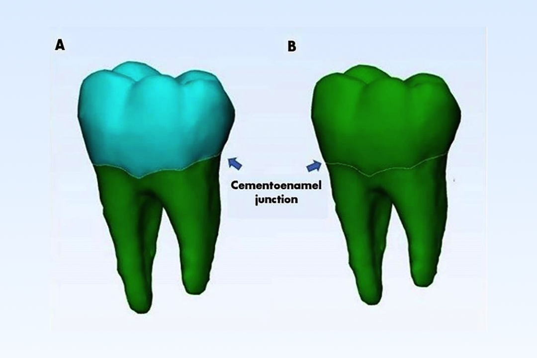 Root Surface Area of Permanent Mandibular Teeth in Patients with Anterior Open Bite Malocclusion: A CBCT Assessment