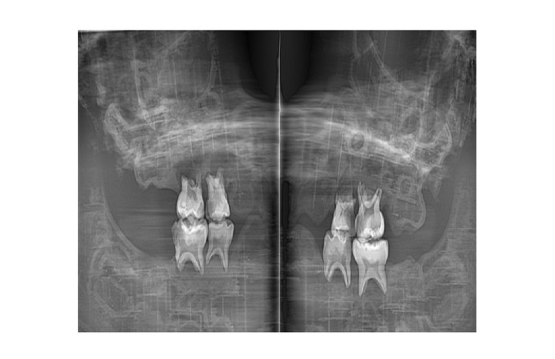 Accuracy of Extraoral Bitewing Compared with Histopathology in Proximal Caries Detection of Primary Molar Teeth